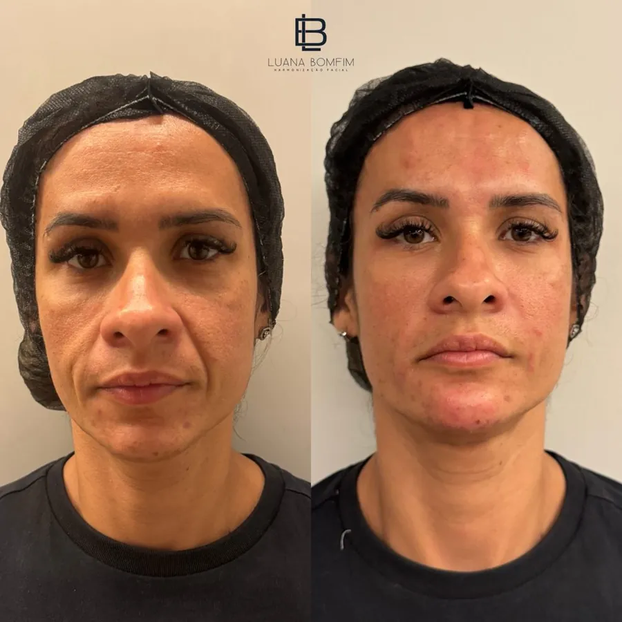 Antes e depois de tratamento do bigode chinês — Dra. Luana Bomfim, Aracaju