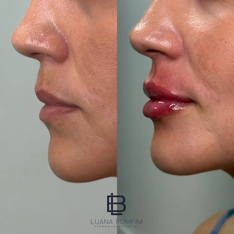 Antes e depois de preenchimento labial perfil e proporção — Dra. Luana Bomfim, Aracaju
