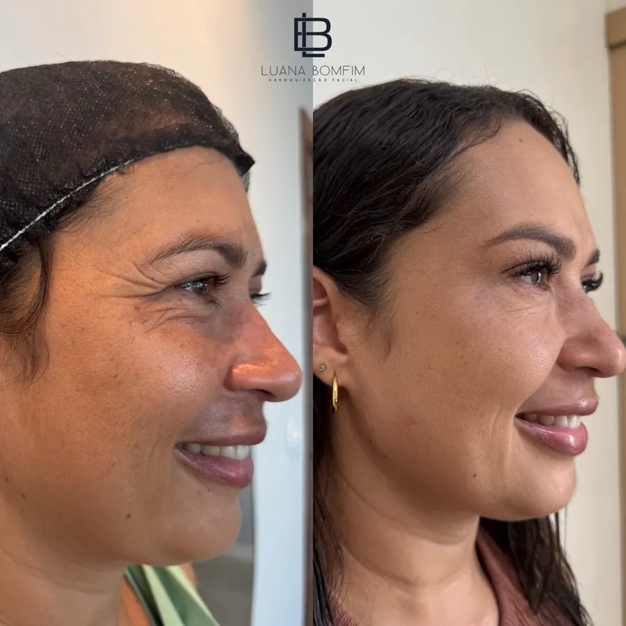 Antes e depois de toxina botulínica para suavização de linhas nos olhos — Dra. Luana Bomfim, Aracaju